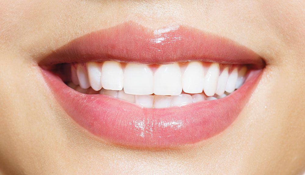 Sourire après un blanchiment dentaire