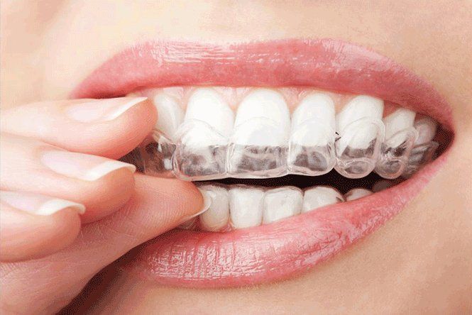Gouttières d'orthodontie invisible